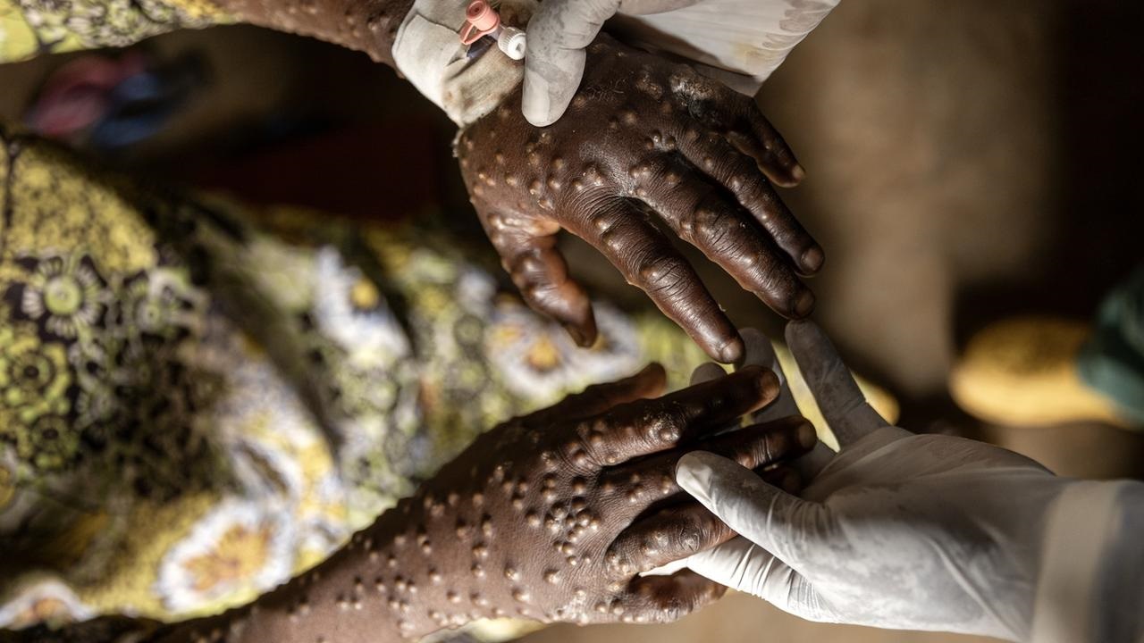 L??pidemie de Mpox continue de s?vir en Afrique centrale