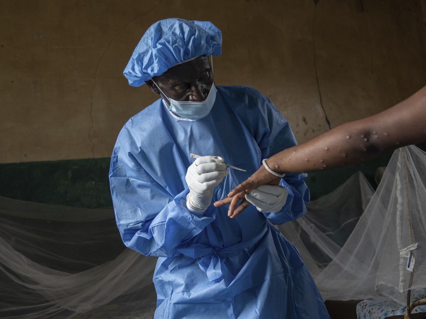 Congo-Brazzaville : ?laboration en cours d&rsquo;un de plan de vaccination contre le Mpox